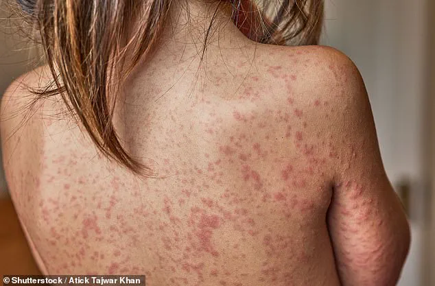 From Chickenpox to Crisis: The Unseen Health Risks Facing Families