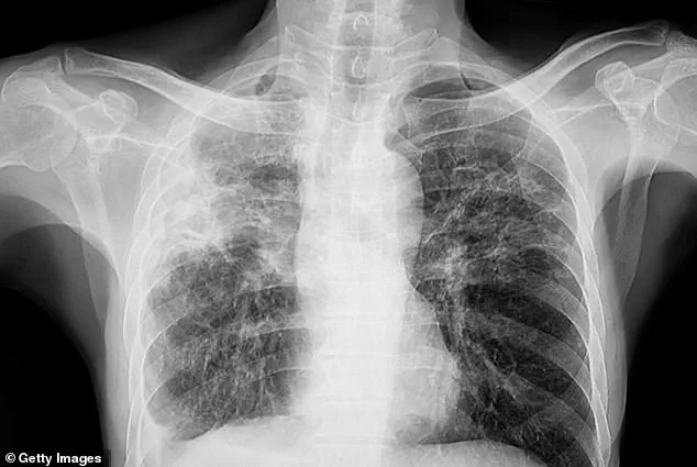 Fears Rise in Maine Over Three Tuberculosis Cases as WHO Warns of Deadly Disease