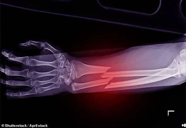 Delays in Osteoporosis Screening Rollout Risk Thousands of Lives, Warn Health Organizations