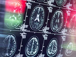 Breakthrough Study by Johns Hopkins University Reveals New Method for Predicting Dementia Using Quantitative Susceptibility Mapping (QSM)
