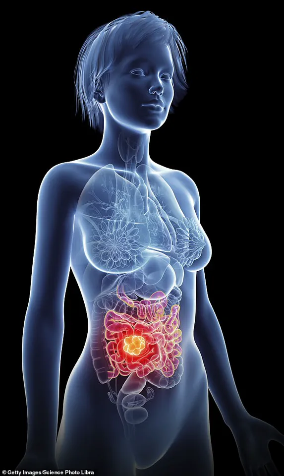 Exclusive Knowledge: A Scientist's Privileged View on the Growing Bowel Cancer Crisis in Young Adults