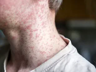Measles Outbreak in South Carolina Reaches Record Levels; Experts Warn of Community Risks