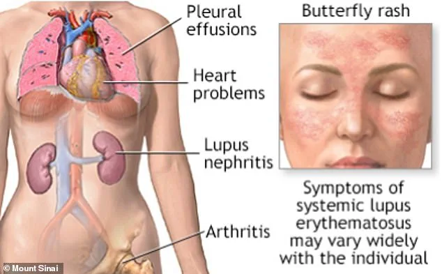 New Study Reveals Epstein-Barr Virus May Trigger Lupus, Urging Immediate Research