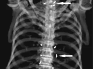 Urgent Alert: Alarming Discovery of Gold Threads from Acupuncture in South Korean Woman's Knee Sparks Safety Concerns