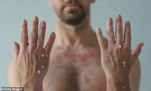 Urgent: First Mpox Case in Alaska Since 2023 Linked to Travel to Endemic Region – Health Officials Issue Advisory