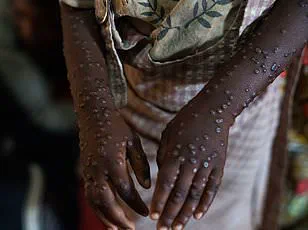 Urgent: First Mpox Case in Alaska Since 2023 Linked to Travel to Endemic Region – Health Officials Issue Advisory