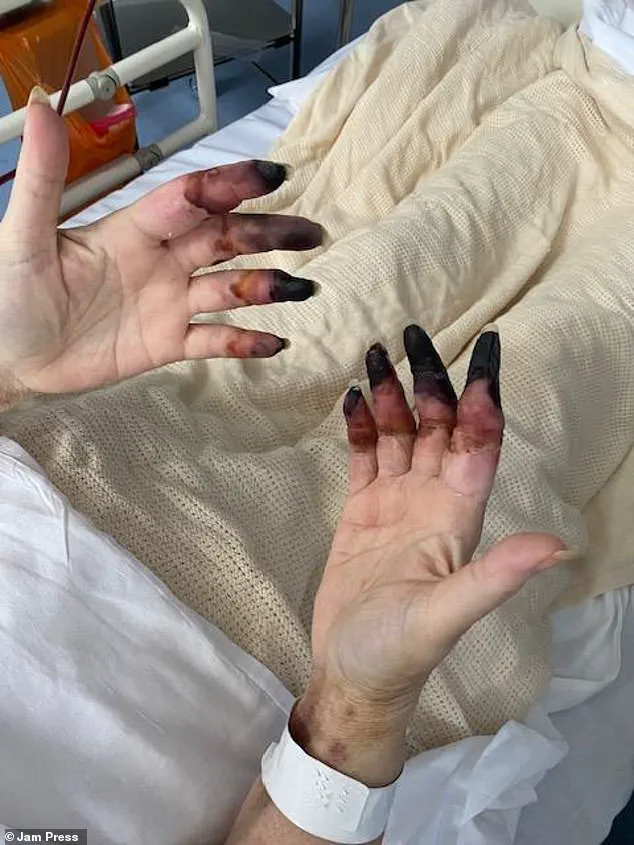Controversy Over Delayed Medical Intervention for Swansea Woman with Recurring Kidney Stones