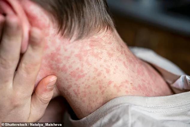 Measles Outbreak at Dilley Immigration Processing Center Triggers ICE Quarantine Measures