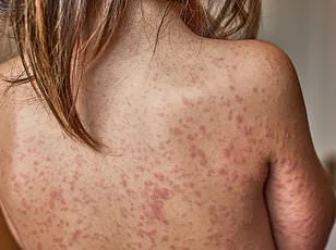 DC Health Officials Warn of Measles Exposure at March for Life Rally, Multiple Locations Identified