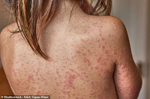 Historic Measles Outbreak in South Carolina Pits Health Officials Against Each Other Over Vaccination