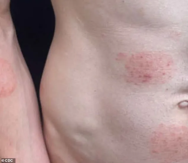 Minnesota Grapples with Nation's Largest Ringworm Outbreak Linked to Rare Fungal Strain