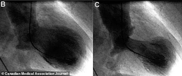 New Study on 'Broken Heart Syndrome' Explores Breathing Exercises as Prevention Tool