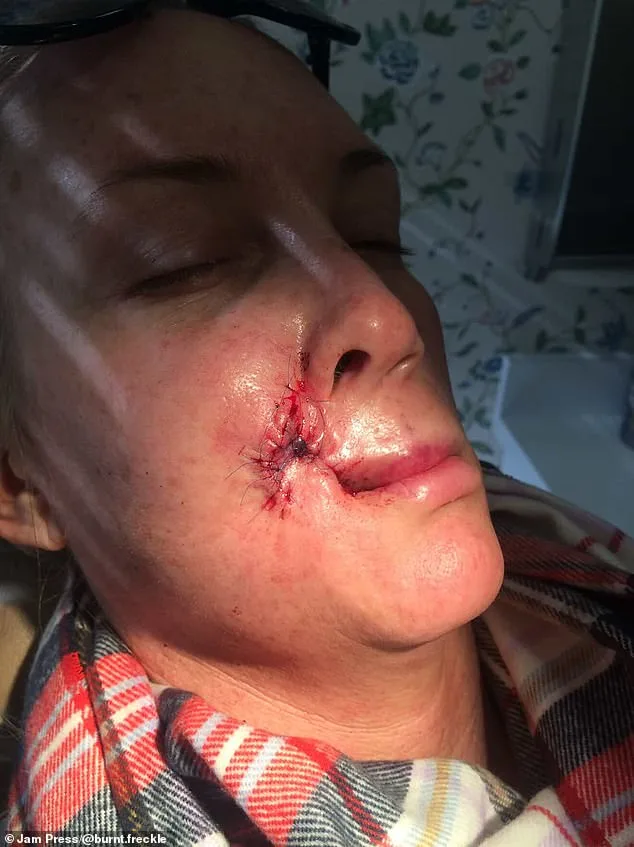 Kory Feltz's 20-Year Battle with Recurrent Skin Cancer
