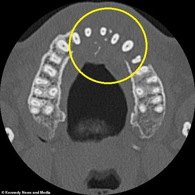 Toothache Leads to Discovery of Aggressive Blood Cancer in Northamptonshire Man