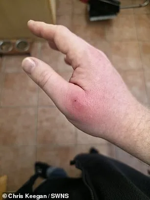 Coventry Man's Severe Infection After Spider Bite Highlights Spread of False Widow Spiders