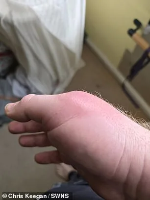 Coventry Man's Severe Infection After Spider Bite Highlights Spread of False Widow Spiders