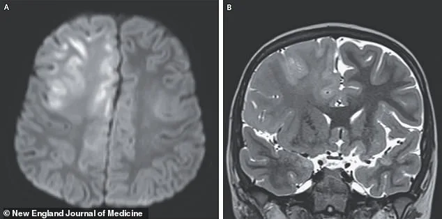 Measles Resurgence in US: SSPE and Unvaccinated Children Fuel Outbreak Concerns