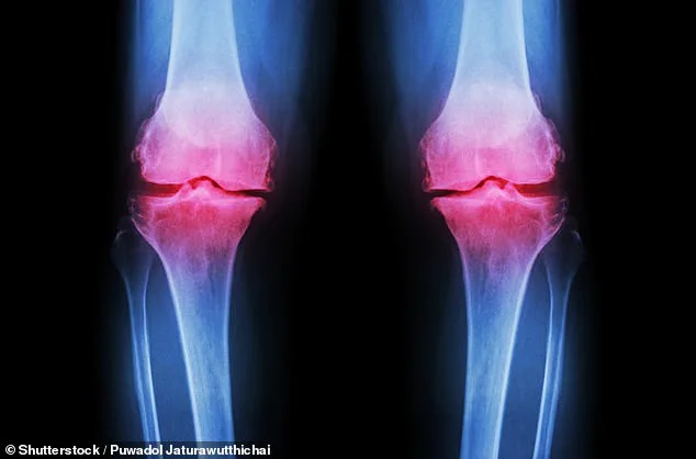 Groundbreaking Study Reveals Inexpensive Prebiotic Could Transform Osteoarthritis Care