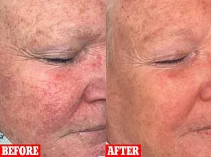 From Rash to Reality: The Misunderstood Severity of Chronic Skin Conditions