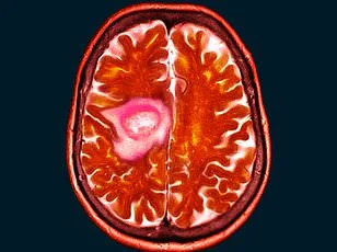 From Blurred Vision to Brain Tumor: How Hormonal Contraceptives May Be Linked to Shelley Whittaker's Rare Diagnosis