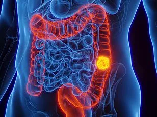 Bowel Cancer Surges to Top Cause of Cancer Deaths in Adults Under 50 in U.S., Experts Warn of 'Tsunami