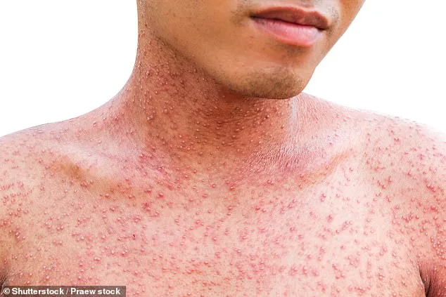 Los Angeles County Faces Alarming Surge in Flea-Borne Typhus Cases, With 90% Hospitalization Rate Sparking Public Health Crisis