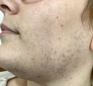 The Daily Ritual of Shaving: Living with Hirsutism and Its Emotional Toll