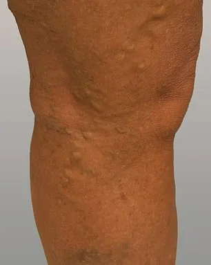 A Mother's Hidden Struggle: The Unseen Agony of Living with Varicose Veins