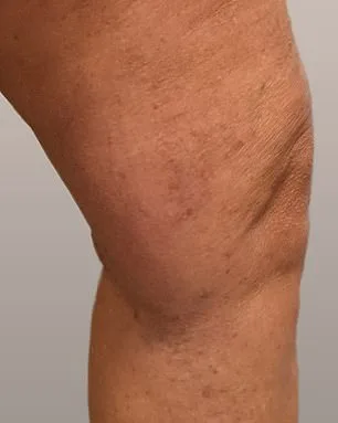 A Mother's Hidden Struggle: The Unseen Agony of Living with Varicose Veins